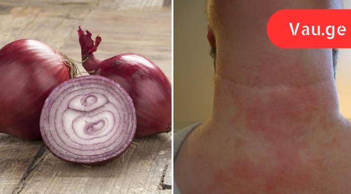 მან ღამით ხახვის კომპრესი გაიკეთა, დილით კი შედეგით უზომოდ გაკვირვებული დარჩა!