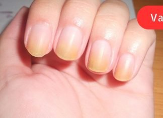 ქალმა ფრჩხილებზე უცნაური ზოლები დაინახა. ვინ იფიქრებდა, რომ ეს გადაარჩენდა მის სიცოცხლეს!