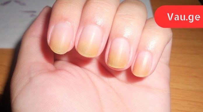 ქალმა ფრჩხილებზე უცნაური ზოლები დაინახა. ვინ იფიქრებდა, რომ ეს გადაარჩენდა მის სიცოცხლეს!