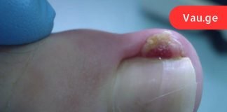 ფრთხილად, ამ დაავადებამ შეიძლება გამოიწვიოს თითის ამპუტაცია! გაიგეთ სიმართლე ჩაზრდილი ფრჩხილების შესახებ.