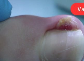 ფრთხილად, ამ დაავადებამ შეიძლება გამოიწვიოს თითის ამპუტაცია! გაიგეთ სიმართლე ჩაზრდილი ფრჩხილების შესახებ.