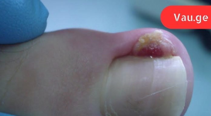 ფრთხილად, ამ დაავადებამ შეიძლება გამოიწვიოს თითის ამპუტაცია! გაიგეთ სიმართლე ჩაზრდილი ფრჩხილების შესახებ.