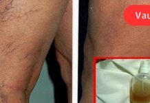 ბალზამი ბუნებრივი ინგრედიენტებისგან: საუკეთესო საშუალება სისხლძარღვთა ქსელის მოსაშორებლად და კანის სილამაზის აღდგენისთვის!