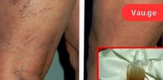 ბალზამი ბუნებრივი ინგრედიენტებისგან: საუკეთესო საშუალება სისხლძარღვთა ქსელის მოსაშორებლად და კანის სილამაზის აღდგენისთვის!