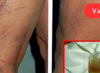 ბალზამი ბუნებრივი ინგრედიენტებისგან: საუკეთესო საშუალება სისხლძარღვთა ქსელის მოსაშორებლად და კანის სილამაზის აღდგენისთვის!