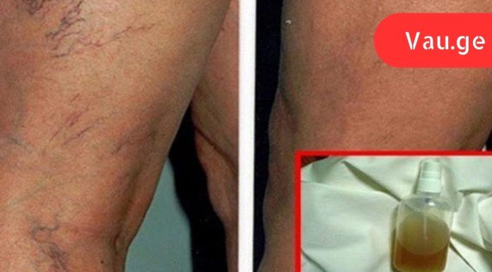 ბალზამი ბუნებრივი ინგრედიენტებისგან: საუკეთესო საშუალება სისხლძარღვთა ქსელის მოსაშორებლად და კანის სილამაზის აღდგენისთვის!