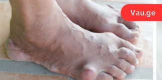 დიახ,ეს დაავადებები ამ დსაკვებიდან გამომდინარეა,საშიში საკვების ჩამონათვალი, რომლებიც ზრდის შარდმჟავას ორგანიზმში!