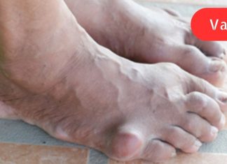 დიახ,ეს დაავადებები ამ დსაკვებიდან გამომდინარეა,საშიში საკვების ჩამონათვალი, რომლებიც ზრდის შარდმჟავას ორგანიზმში!