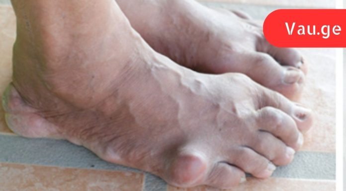 დიახ,ეს დაავადებები ამ დსაკვებიდან გამომდინარეა,საშიში საკვების ჩამონათვალი, რომლებიც ზრდის შარდმჟავას ორგანიზმში!