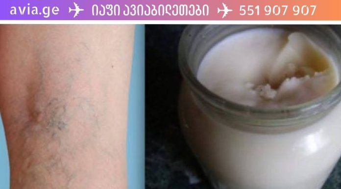 ჩვენი წინაპრების რეცეპტი: დავიწყებული ჯადოსნური მალამო ვარიკოზული ვენებისთვის