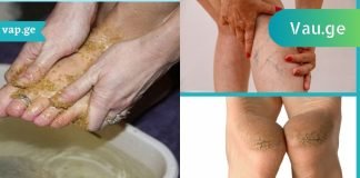 შეიზილეთ ეს პროდუქტი ფეხებზე და დაემშვიდობეთ ვენების ვარიკოზს.