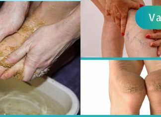 შეიზილეთ ეს პროდუქტი ფეხებზე და დაემშვიდობეთ ვენების ვარიკოზს.