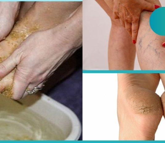 შეიზილეთ ეს პროდუქტი ფეხებზე და დაემშვიდობეთ ვენების ვარიკოზს.