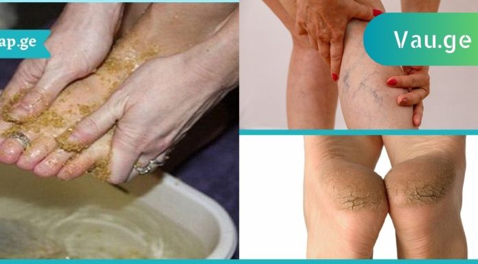 შეიზილეთ ეს პროდუქტი ფეხებზე და დაემშვიდობეთ ვენების ვარიკოზს.